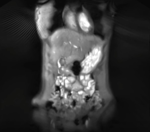 Visualization of gastric motility affecting an enteric-coated capsule. T1-weighted, real-time MRI (FLASH2) video of the abdomen in a lying position.