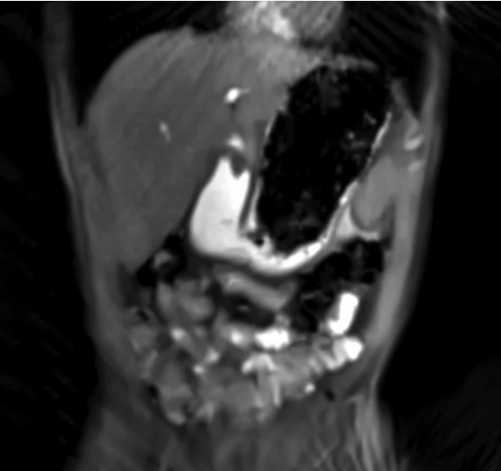 Visualization of the Magenstrasse. T1-weighted real-time MRI (FLASH2) video