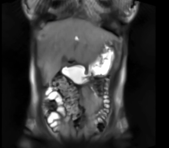 Visualization of gastric motility. T1-weighted, real-time MRI (FLASH2) video
