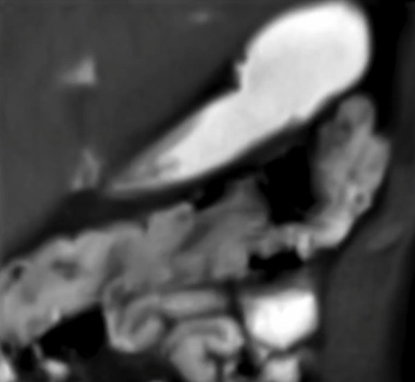 Visualization of mass movement in the transversal colon. T1-weighted, real-time MRI (FLASH2) video