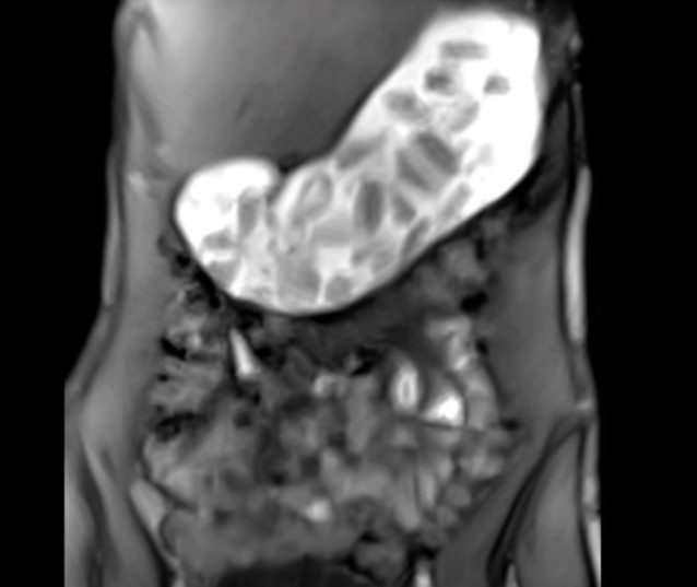 Visualization of postprandial motility. T1-weighted real-time MRI (FLASH2) video of the abdomen after intake of a meal
