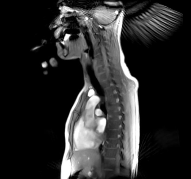 Visualization of the process of swallowing and esophageal transit of a capsule. T1-weighted, real-time MRI (FLASH2) video
